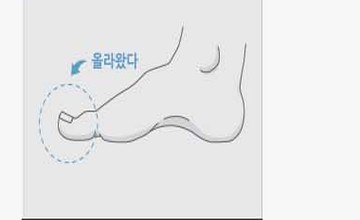 발가락 길이 조정이 필요한 사람